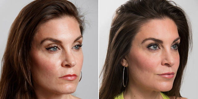Vienna botox model before and after