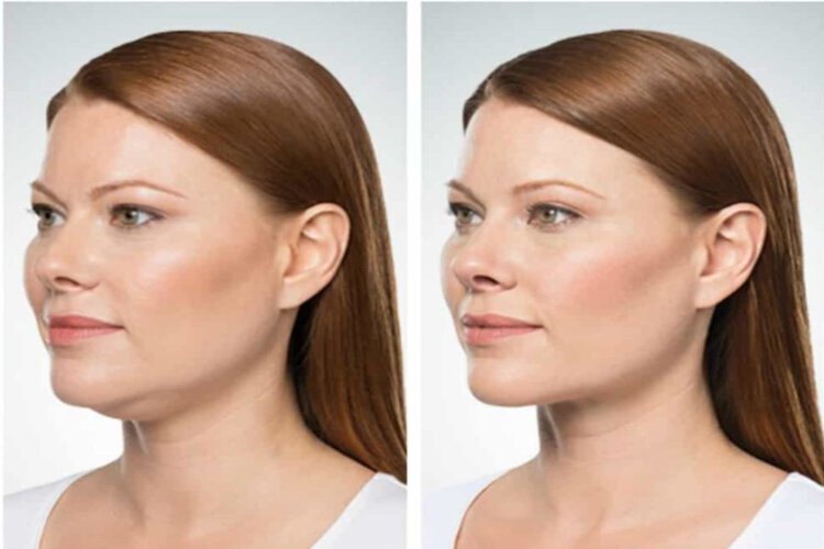 Vienna kybella model before and after
