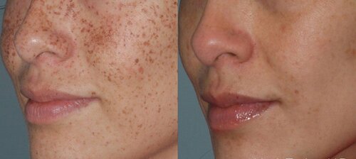 Vienna laser model before and after