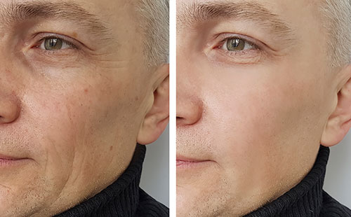 Vienna prp injection model before and after