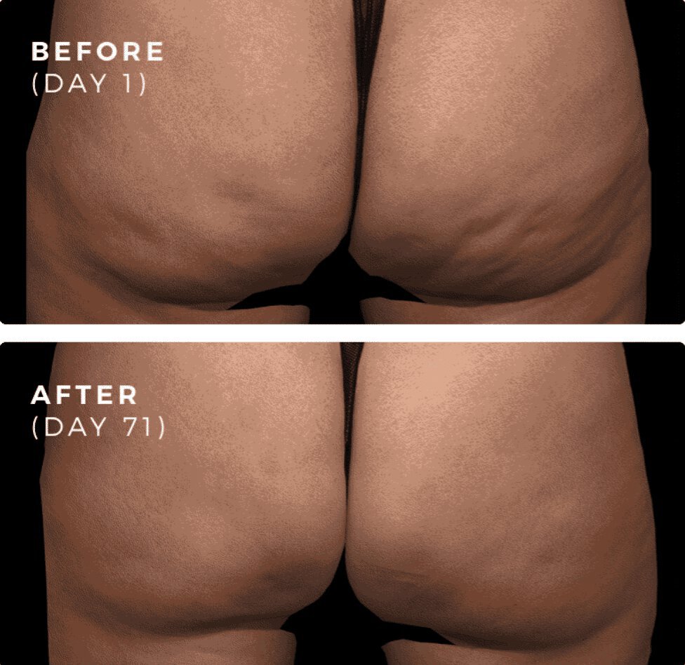 Vienna qwo for cellulite reduction before and after