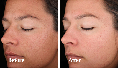 Vienna Chemical peel patient before and after