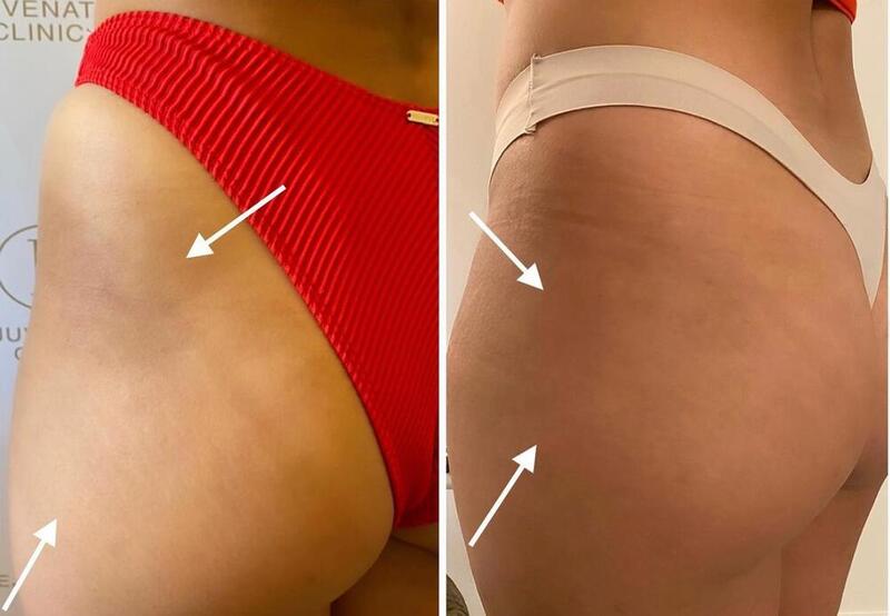 Buttocks Enhancement Before & After Image